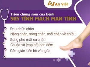 Cách nhận biết suy giãn tĩnh mạch