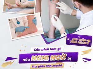 Biểu hiện của giãn tĩnh mạch