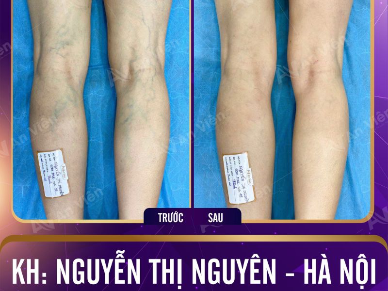 Bị tê chân phải làm sao