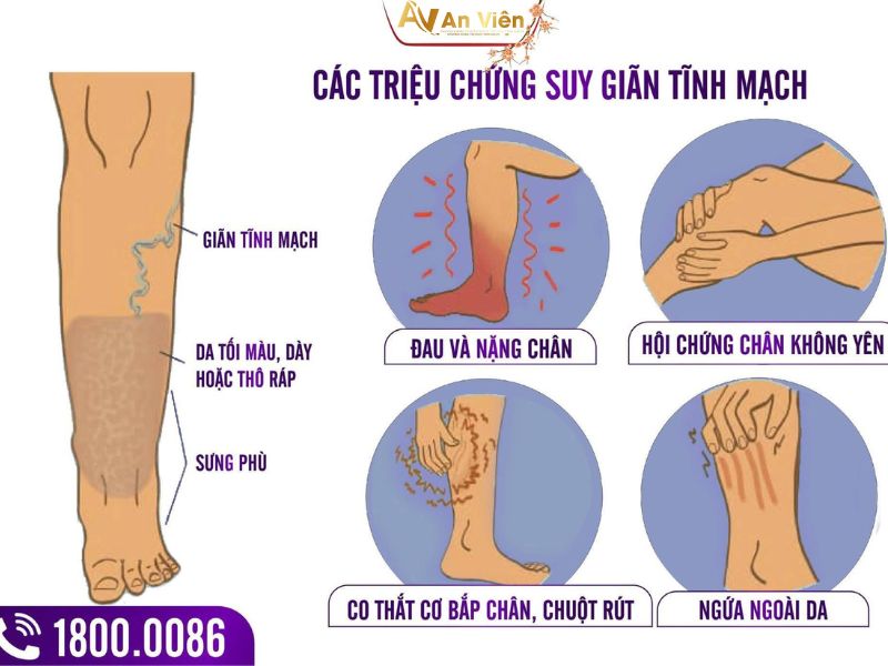 Bị tê chân phải làm sao