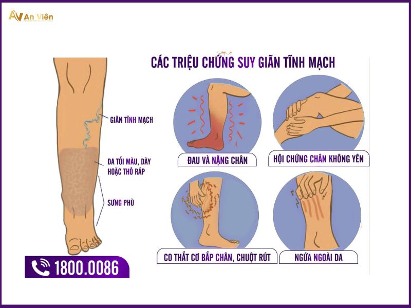 chữa suy giãn tĩnh mạch tại nhà