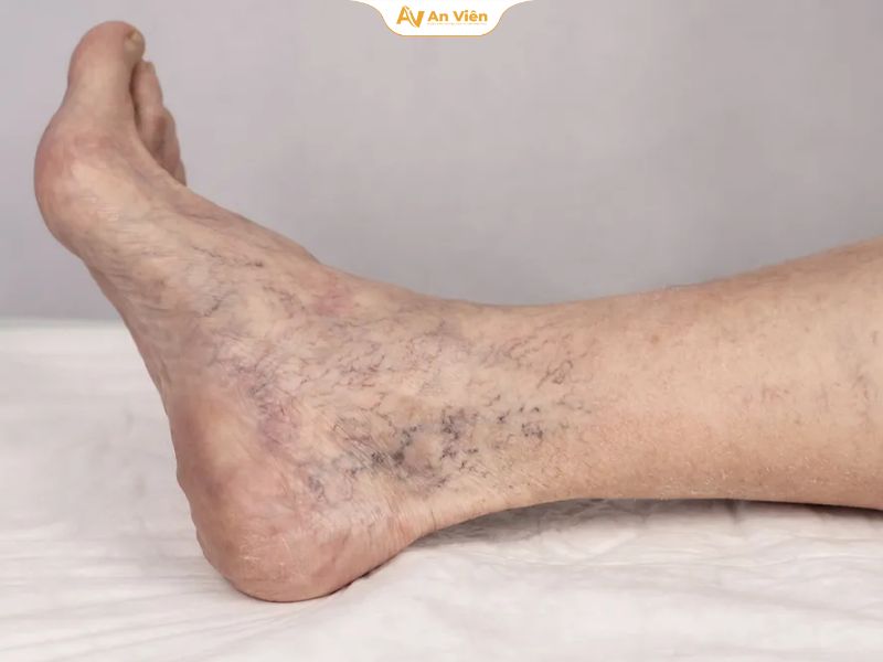 Nổi tĩnh mạch ở chân có nguy hiểm không?