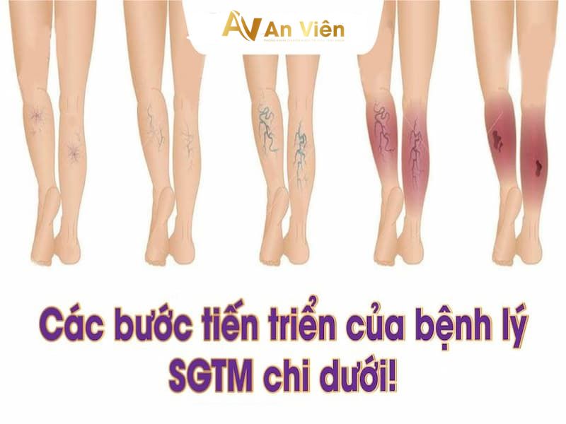 Khám bệnh giãn tĩnh mạch chân ở đâu đảm bảo? 6 Khám bệnh giãn tĩnh mạch chân ở đâu