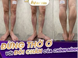 mắt cá chân bị sưng và ngứa