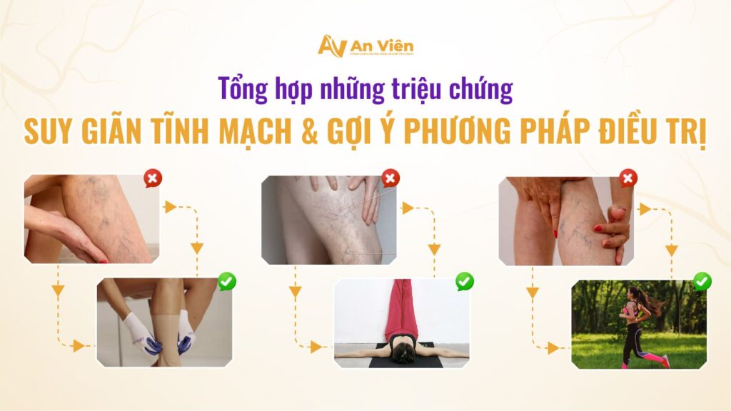 Tổng hợp những triệu chứng suy giãn tĩnh mạch