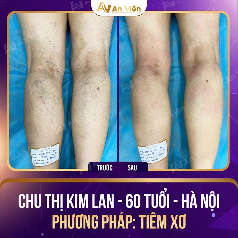 Trung tâm điều trị suy giãn tĩnh mạch An Viên