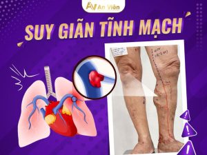 bệnh suy giãn tĩnh mạch có chữa khỏi được không