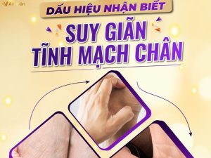 chân giãn tĩnh mạch là gì