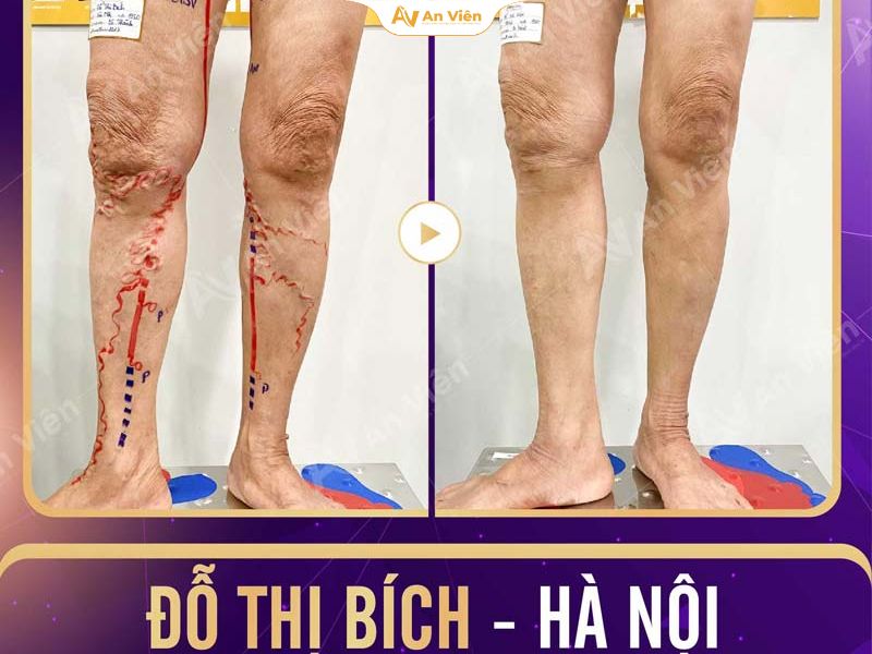 Hiệu quả mang lại khi điều trị suy giãn tĩnh mạch bằng laser