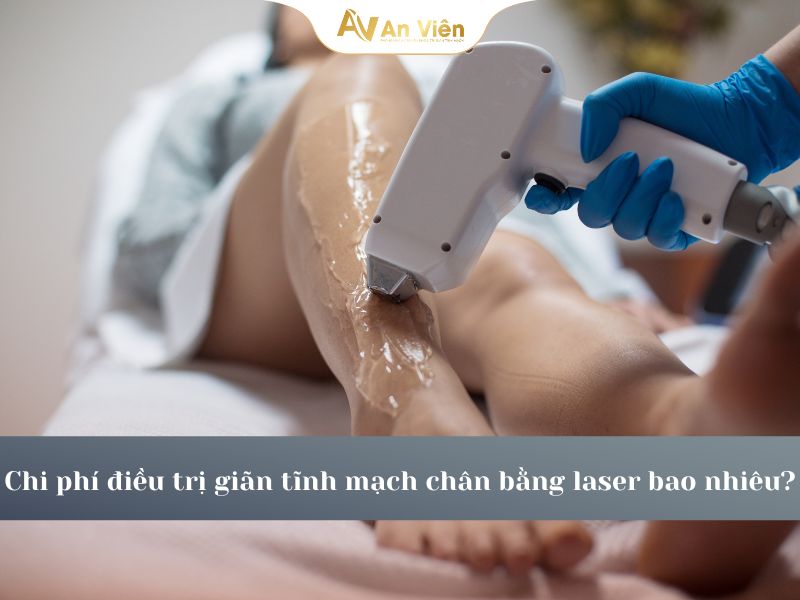 Chi phí điều trị giãn tĩnh mạch chân bằng laser bao nhiêu?
