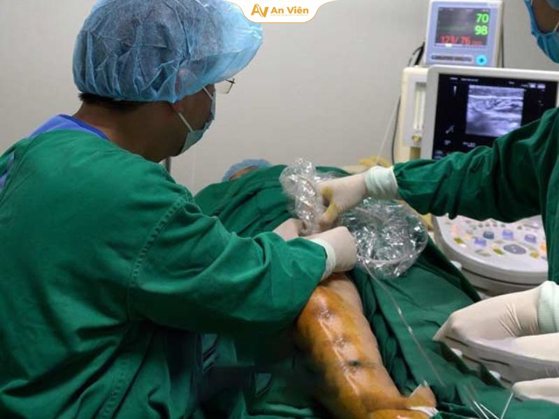 Người phụ nữ và đôi chân biến dạng sau 15 năm bị suy giãn tĩnh mạch hành hạ 4 Quy trình thực hiện laser