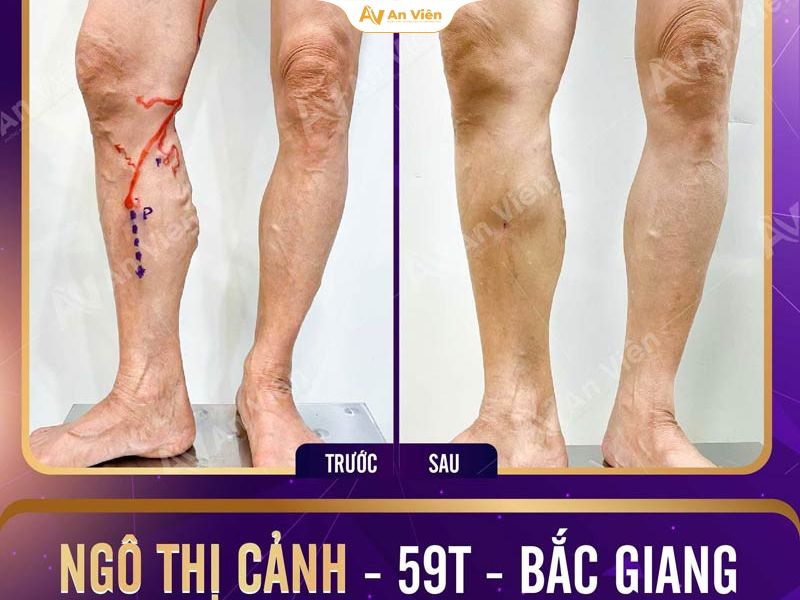 Bệnh nhân điều trị suy giãn tĩnh mạch bằng phương pháp laser tại Tĩnh mạch An Viên