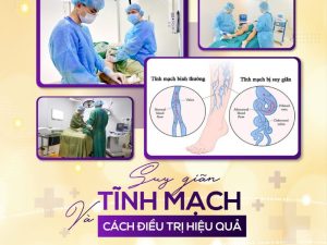 chích xơ giãn tĩnh mạch