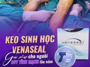điều trị suy giãn tĩnh mạch bằng keo sinh học