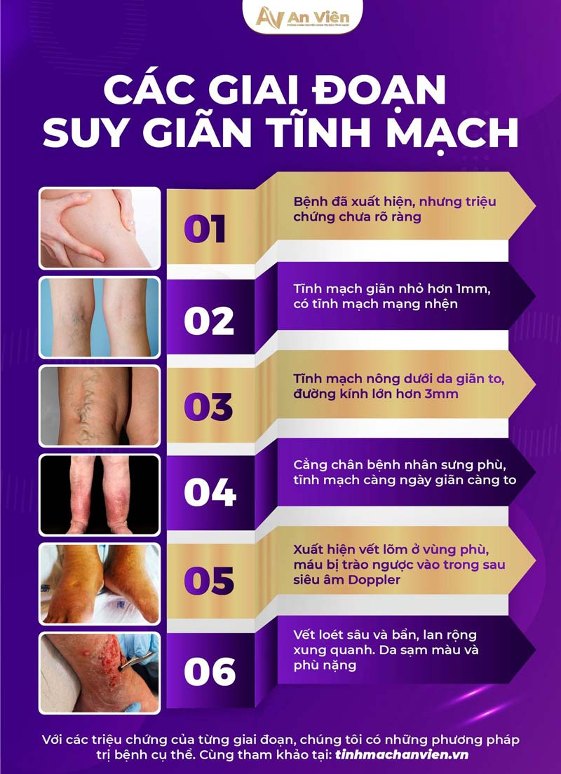 điều trị suy giãn tĩnh mạch bằng laser 