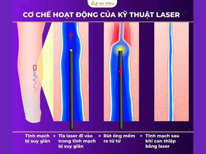 điều trị suy giãn tĩnh mạch bằng laser 
