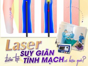 điều trị suy giãn tĩnh mạch bằng laser