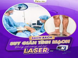 đốt laser suy giãn tĩnh mạch