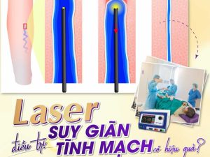 laser tĩnh mạch an viên