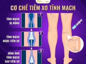 tiêm xơ tĩnh mạch có nguy hiểm không