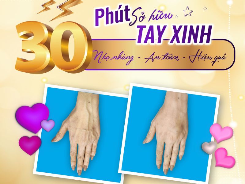 Tiêm xơ tĩnh mạch tay An Viên - Khắc tinh của gân xanh ở tay 12 tiêm xơ tĩnh mạch tay