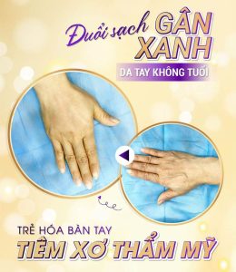 tiêm xơ tĩnh mạch tay hai