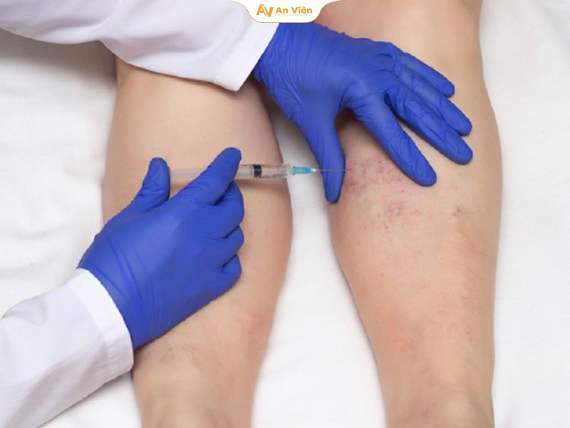 Bác sĩ chữa suy giãn tĩnh mạch giỏi