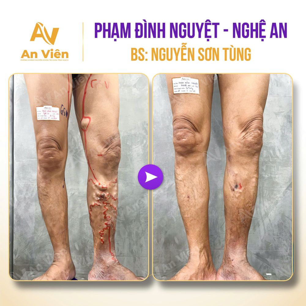 Bác sĩ chữa suy giãn tĩnh mạch giỏi
