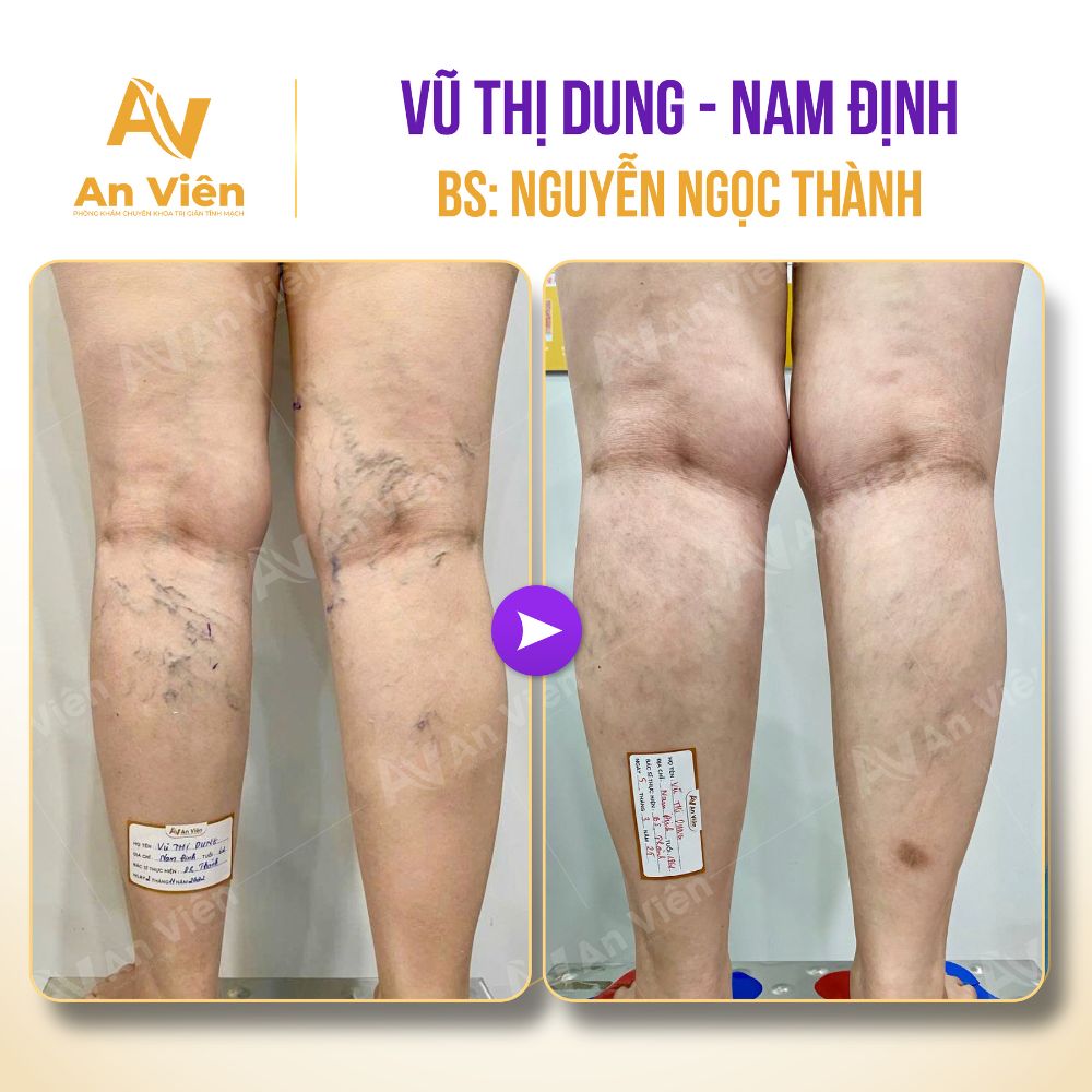 Bác sĩ chữa suy giãn tĩnh mạch giỏi