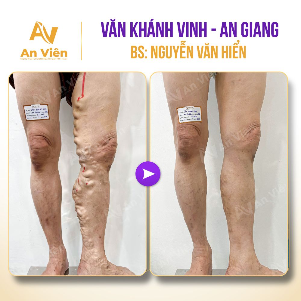 Bác sĩ chữa suy giãn tĩnh mạch giỏi