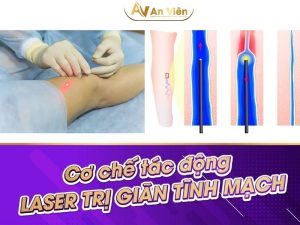 bắn laser giãn tĩnh mạch bao nhiêu tiền