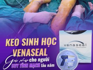 bơm keo sinh học điều trị suy giãn tĩnh mạch