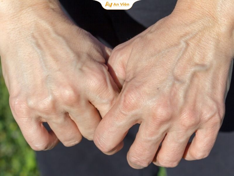 Cách trị tê tay khi ngủ hiệu quả và phòng ngừa tái phát tại nhà 17 Suy giãn tĩnh mạch