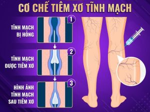 có nên tiêm xơ tĩnh mạch
