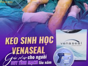 điều trị suy giãn tĩnh mạch bằng keo sinh học