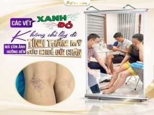 nên làm gì khi bị suy giãn tĩnh mạch