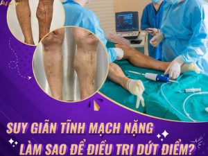 phương pháp điều trị suy giãn tĩnh mạch