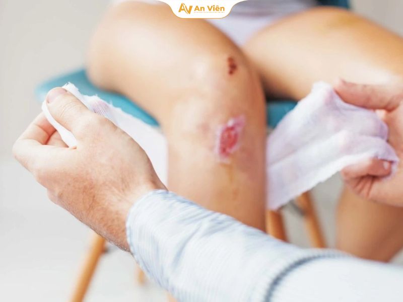 Người có vết thương hở