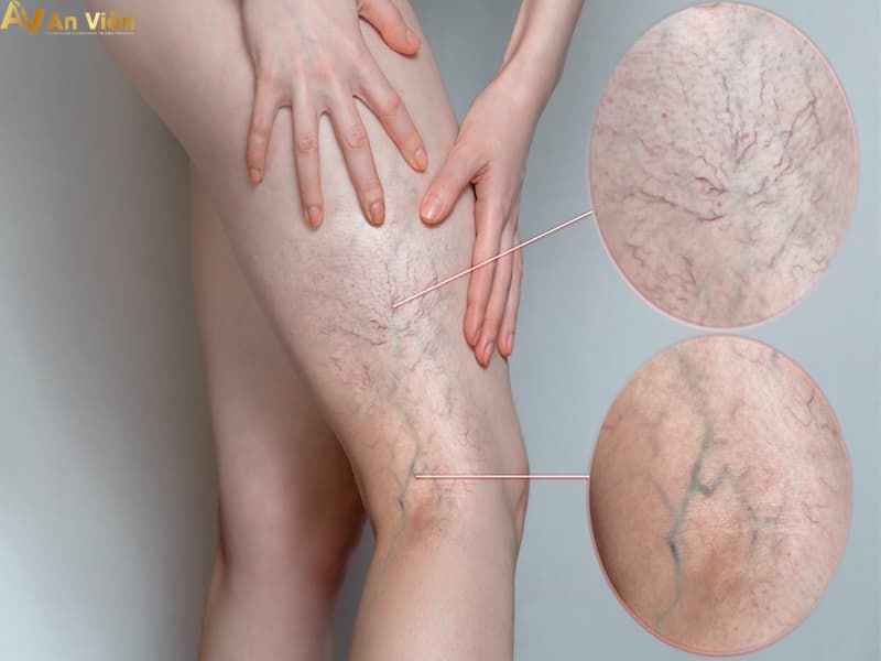 4 dấu hiệu suy giãn tĩnh mạch