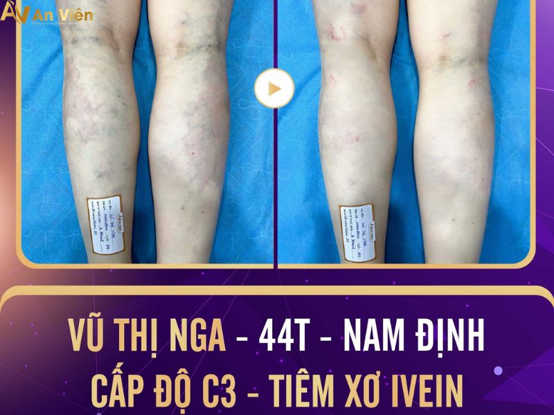 hiện tượng suy giãn tĩnh mạch