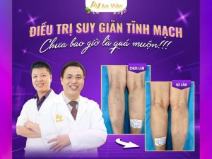 suy giãn tĩnh mạch cách điều trị