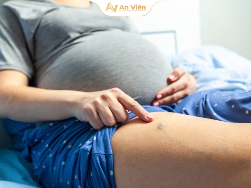 Giãn tĩnh mạch độ 3: Nguyên nhân, dấu hiệu và hướng điều trị 19 Suy giãn tĩnh mạch cấp độ 3