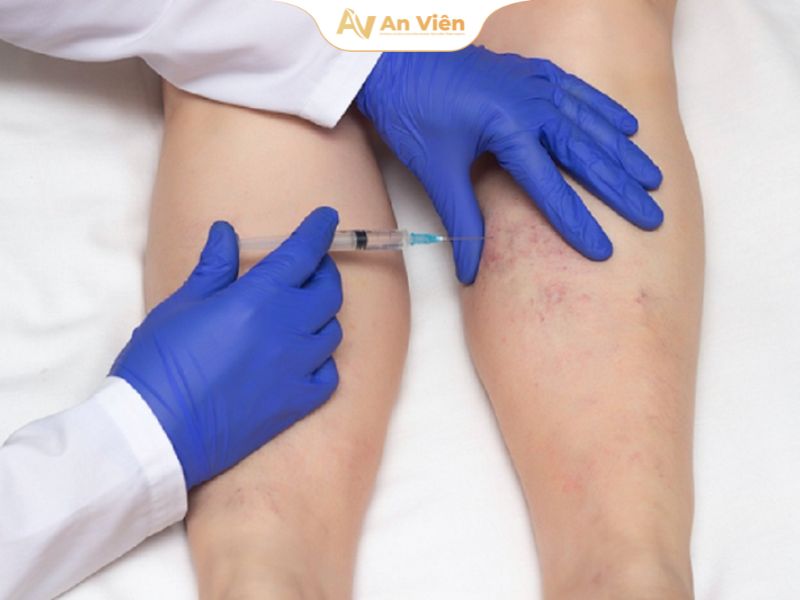 Giãn tĩnh mạch độ 3: Nguyên nhân, dấu hiệu và hướng điều trị 20 Suy giãn tĩnh mạch cấp độ 3