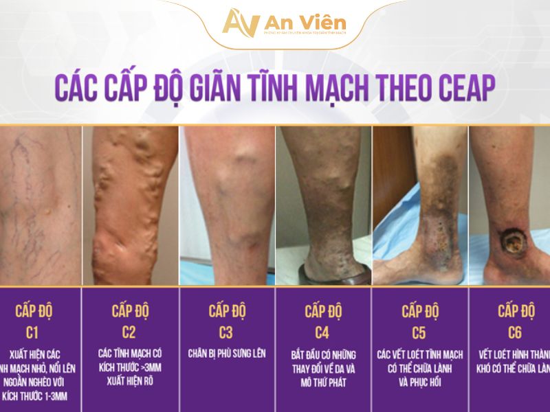 Giãn tĩnh mạch độ 3: Nguyên nhân, dấu hiệu và hướng điều trị 13 Suy giãn tĩnh mạch cấp độ 3
