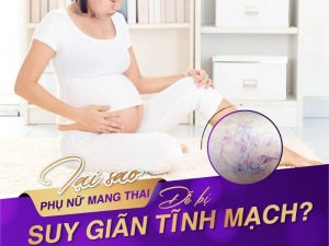 suy giãn tĩnh mạch sau sinh