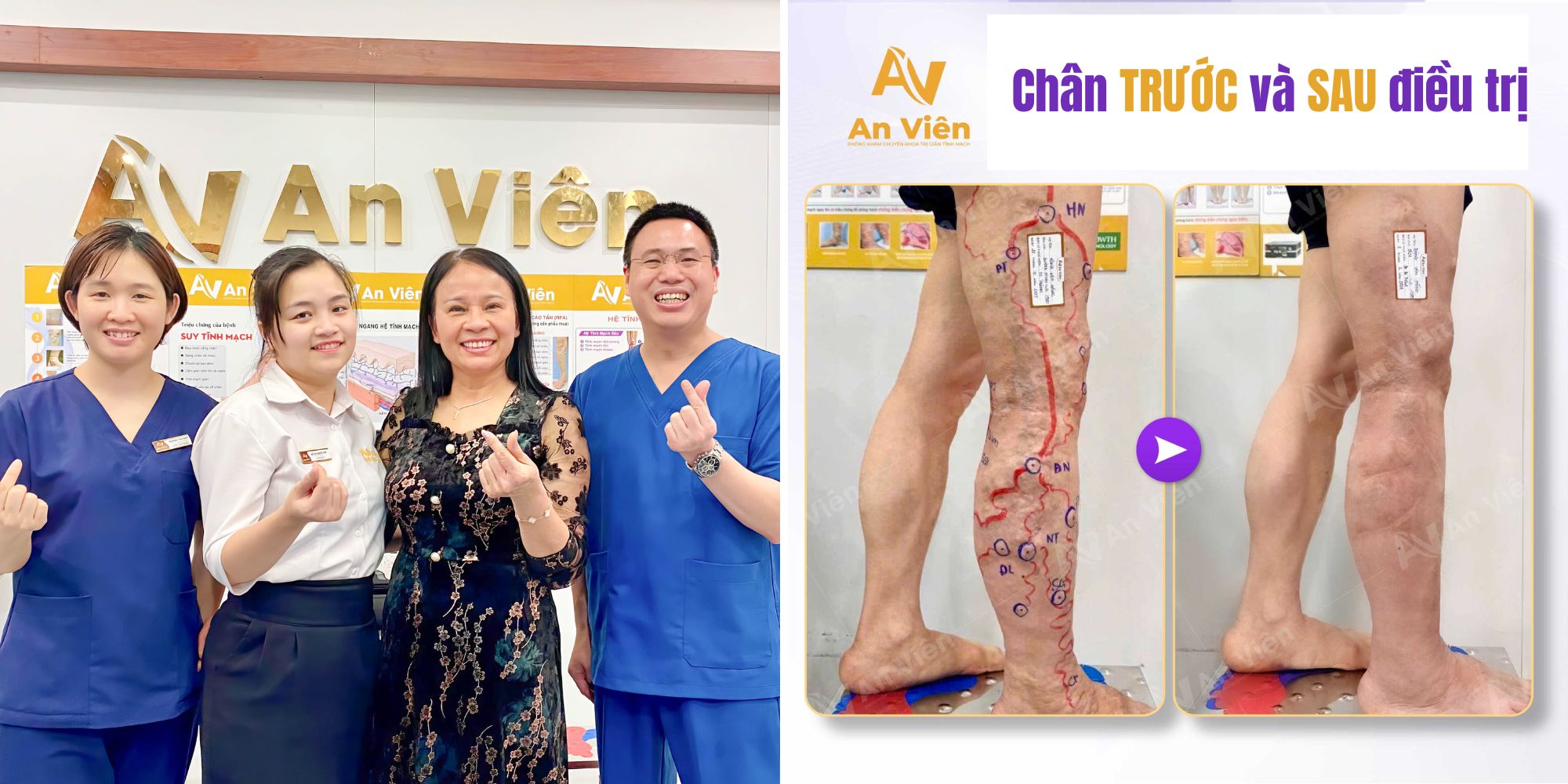 Suy giãn tĩnh mạch có phải mổ không