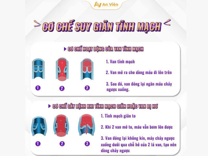 Suy giãn tĩnh mạch có phải mổ không