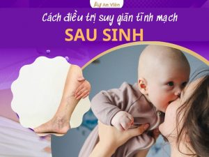 suy giãn tĩnh mạch chân sau sinh