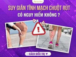 suy giãn tĩnh mạch chuột rút
