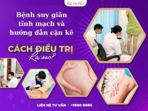 hướng dẫn cặn kẽ cách chữa suy giãn tĩnh mạch